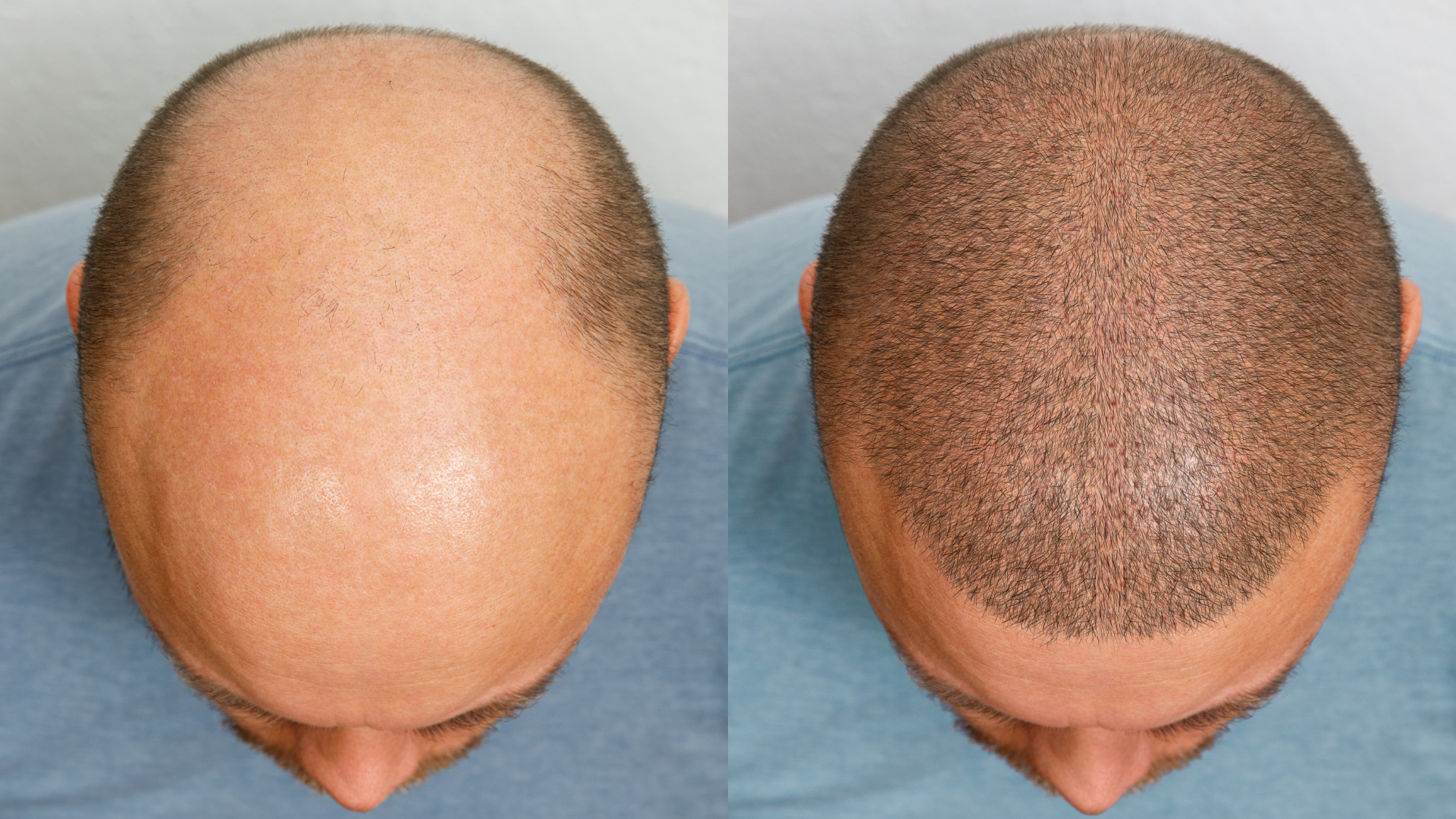 Live Hair Clinic – İstanbul’da Güvenilir Saç Ekimi Merkezi